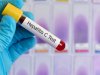 Hepatitis C Unveiled: Risks, Prevention, and Modern Treatment Methods