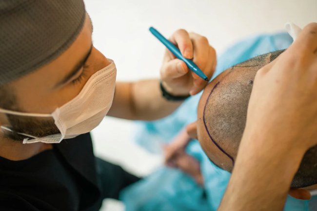 Affordable Hair Transplant In Turkey:  A Comprehensive Guide for You