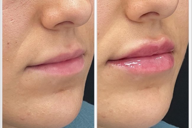 Affordable Beauty: Exploring the Juvederm Lip Injections