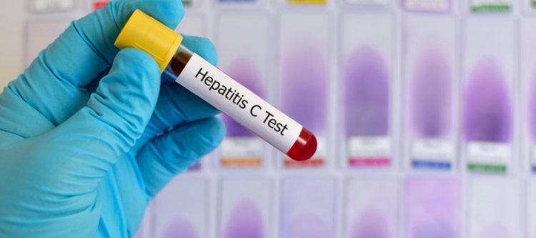 Hepatitis C Unveiled: Risks, Prevention, and Modern Treatment Methods