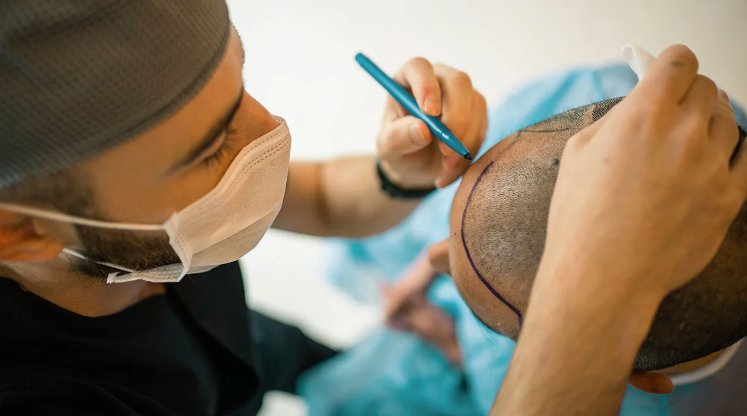 Affordable Hair Transplant In Turkey: A Comprehensive Guide for You